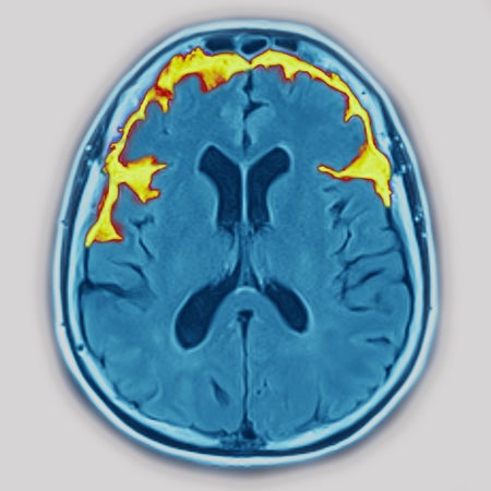 Radial section of the brain visualized by an MRI.