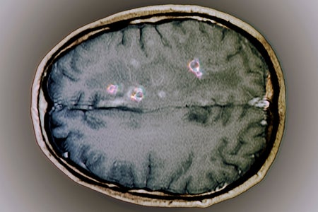 Tapeworm cysts in the brain. Magnetic resonance imaging (MRI) scan of an axial section through the brain of a 25 year old patient showing cysts (neurocysticercosis, purple) from a tapeworm infection. The cysts have been highlighted by the injection of gadolinium contrast medium.